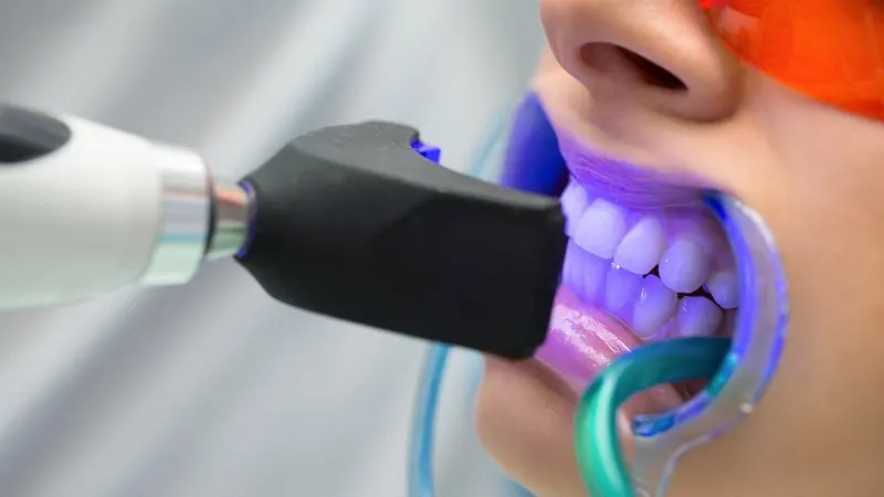 Blanqueamiento dental: errores habituales antes de empezar