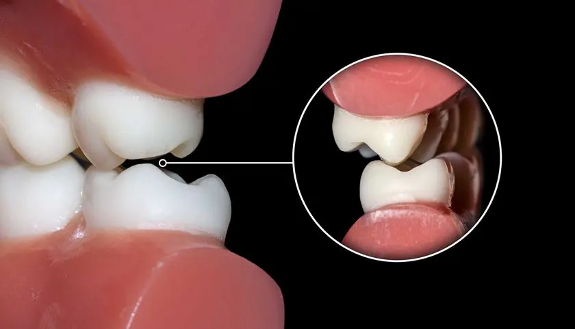 Bruxismo y dolor mandibular: cuándo consultar