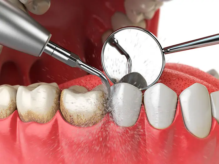 Periodoncia y encías en Santa Cruz de Tenerife