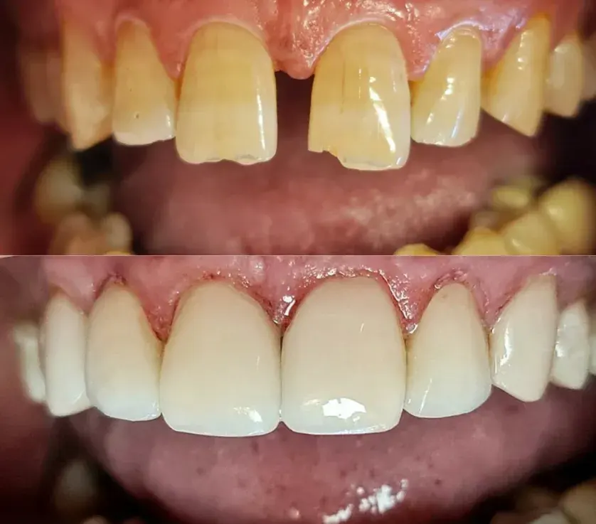 Diseño de sonrisa