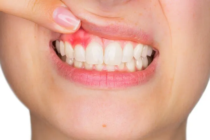 Encías inflamadas o sangrantes: señales que no conviene ignorar