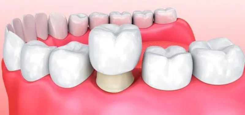 Coronas y fundas dentales en Santa Cruz de Tenerife
