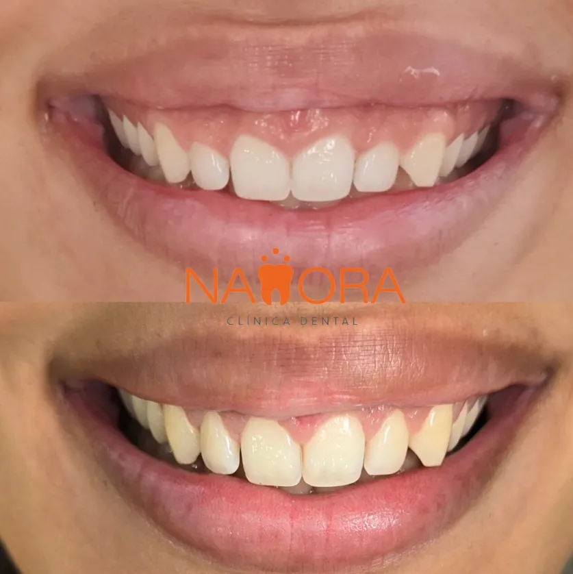 Gingivectomía estética