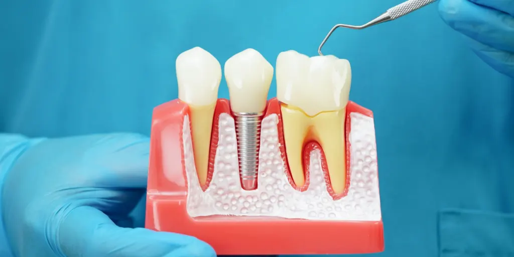 Implantes dentales: cuidados clave después del tratamiento