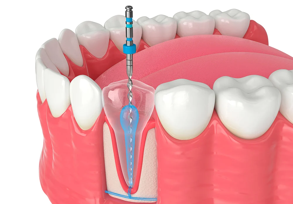 Endodoncia en Santa Cruz de Tenerife