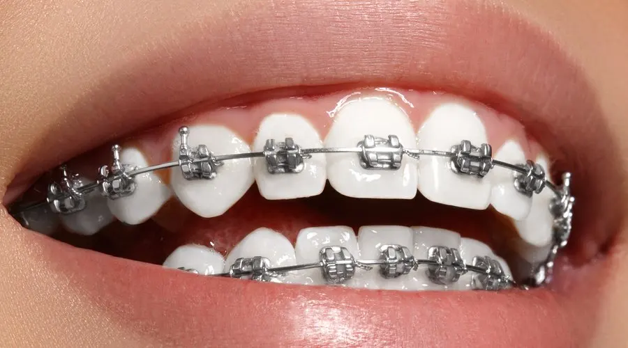 Ortodoncia con brackets en Santa Cruz de Tenerife