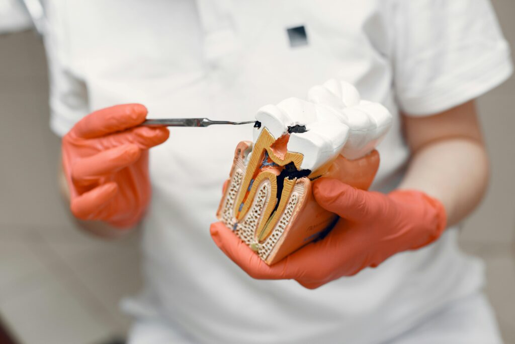 Dentista señalando los problemas que pueden causar las caries